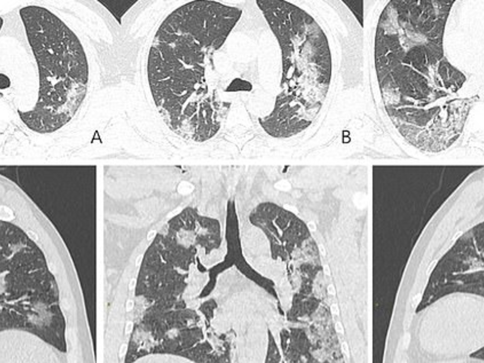 Weiße flecken röntgenbild lunge Weiße Flecken