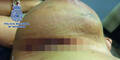 Kokain Implantate