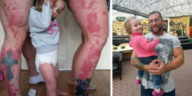 Birthmark Baby