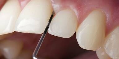 Freiliegende Zahnhälse verursachen Wurzelkaries