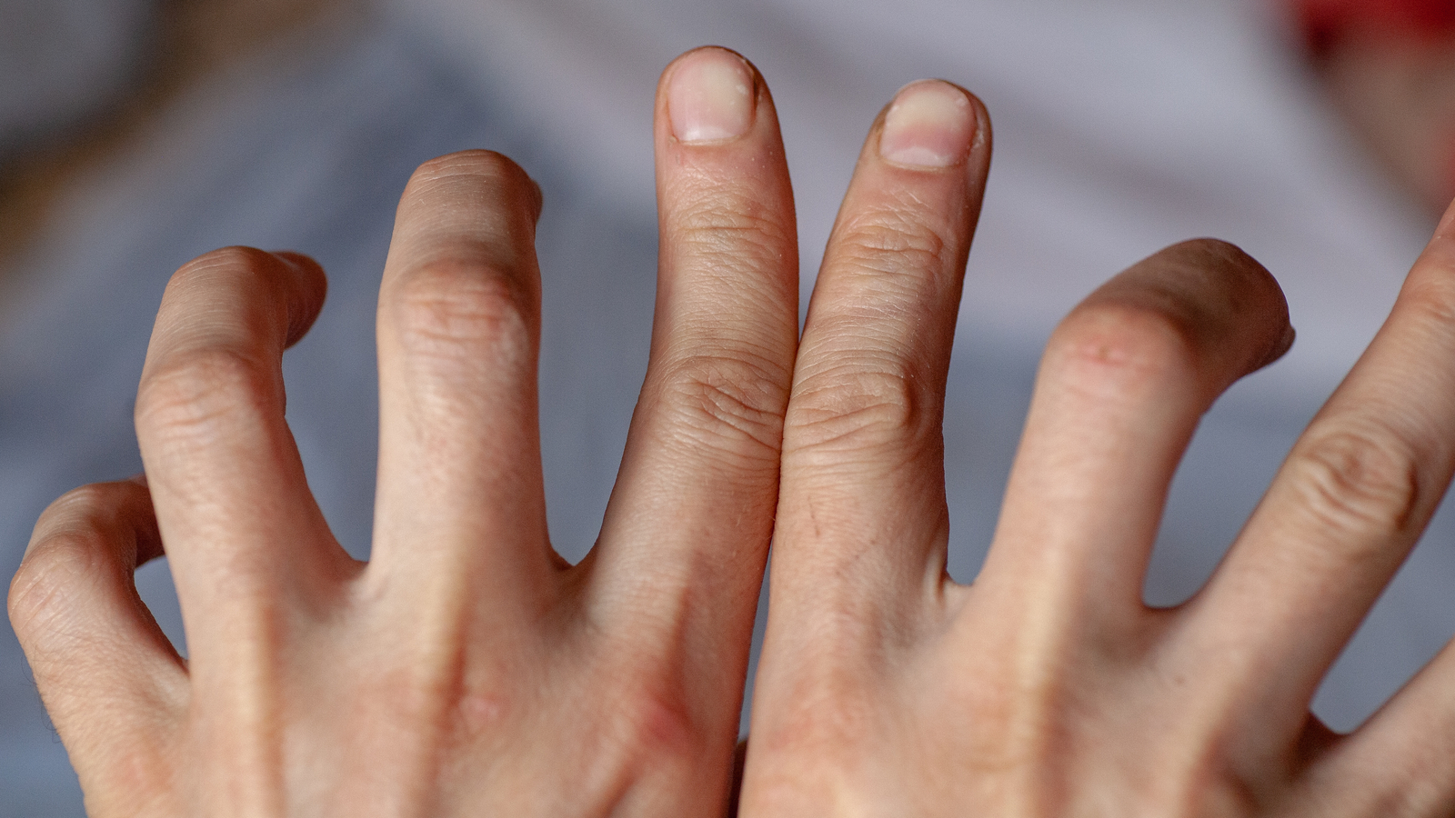 Wenn sich die Finger krümmen gesund24.at
