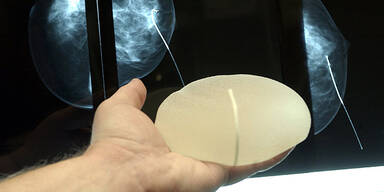 Brustimplantat Silikon