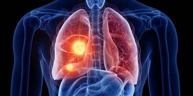 Lungenkrebs - Was gibt es Neues?