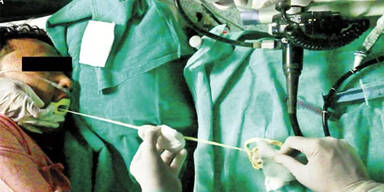 Ärzte ziehen 2-Meter-Bandwurm aus Mund eines Mannes