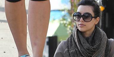 Kim Kardashian leidet unter Schuppenflechte