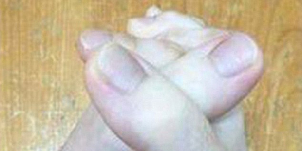 Finger oder Zehen? Foto lässt Netz ausflippen