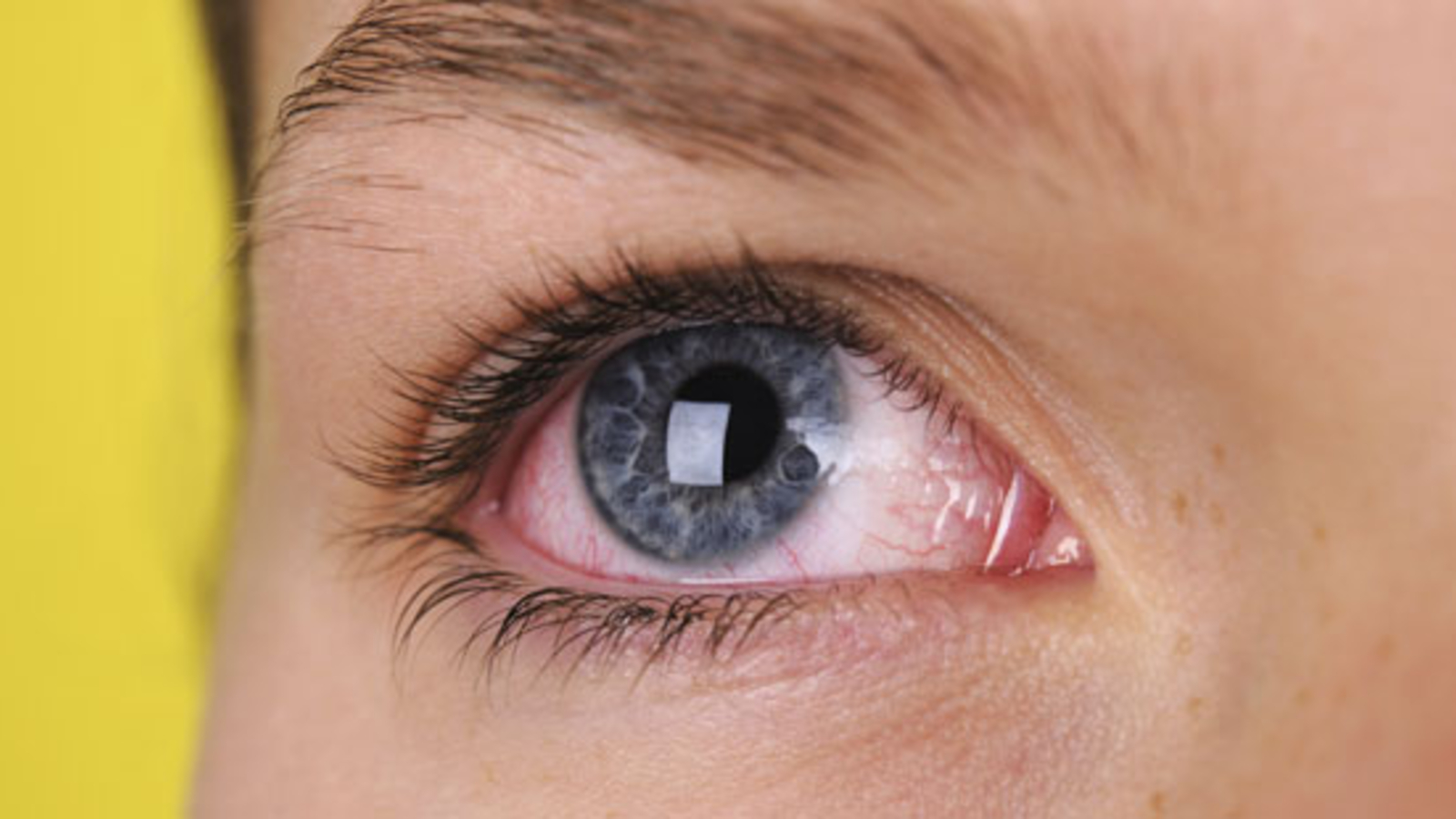 Warum Sie trockene Augen ernst nehmen sollten