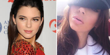 Kendall Jenner zeigt Schlauchboot-Lippen