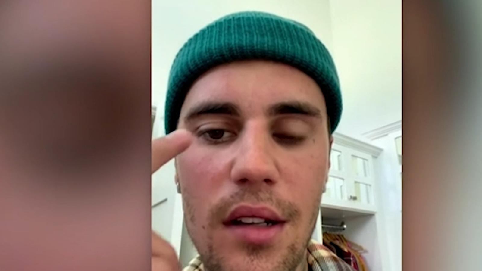 Justin Bieber Gesichtslahmung Heilung