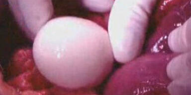 Mann wuchs Riesen-Ei aus Gummi im Bauch