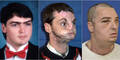 Richard Lee Norris Gesichtstransplantation