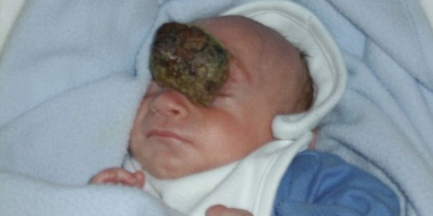 Baby mit Hirn am Gesicht geboren