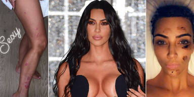 Kim Kardashian Schuppenflechte