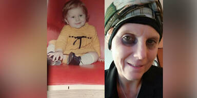 Letzte Chance, um Tumor zu besiegen: 47-Jährige sucht ihre leibliche Mutter