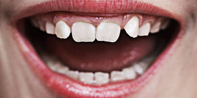 Weichmacher schuld an schlechten Zähnen?