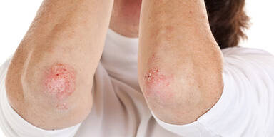 Psoriasis: Hautkrankheit mit Tücken