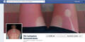 Facebook-Seite zeigt die ärgsten Sonnenbrände