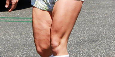 Cellulite: Wem gehören diese Beine?